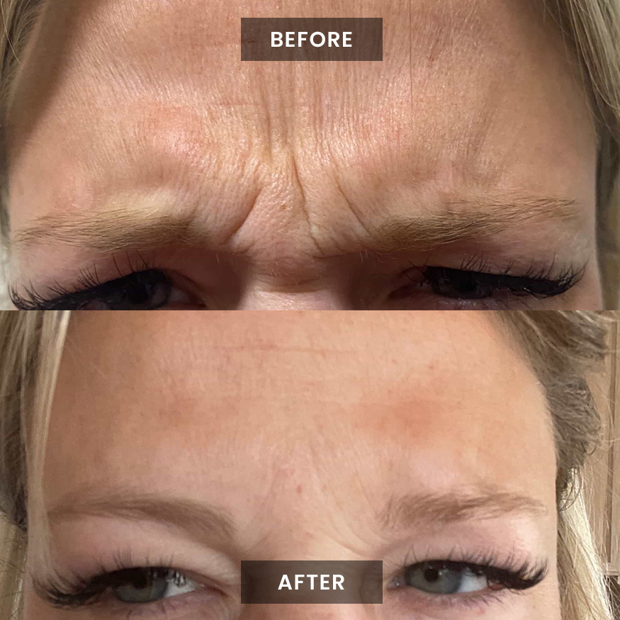 Xeomin before and after photo