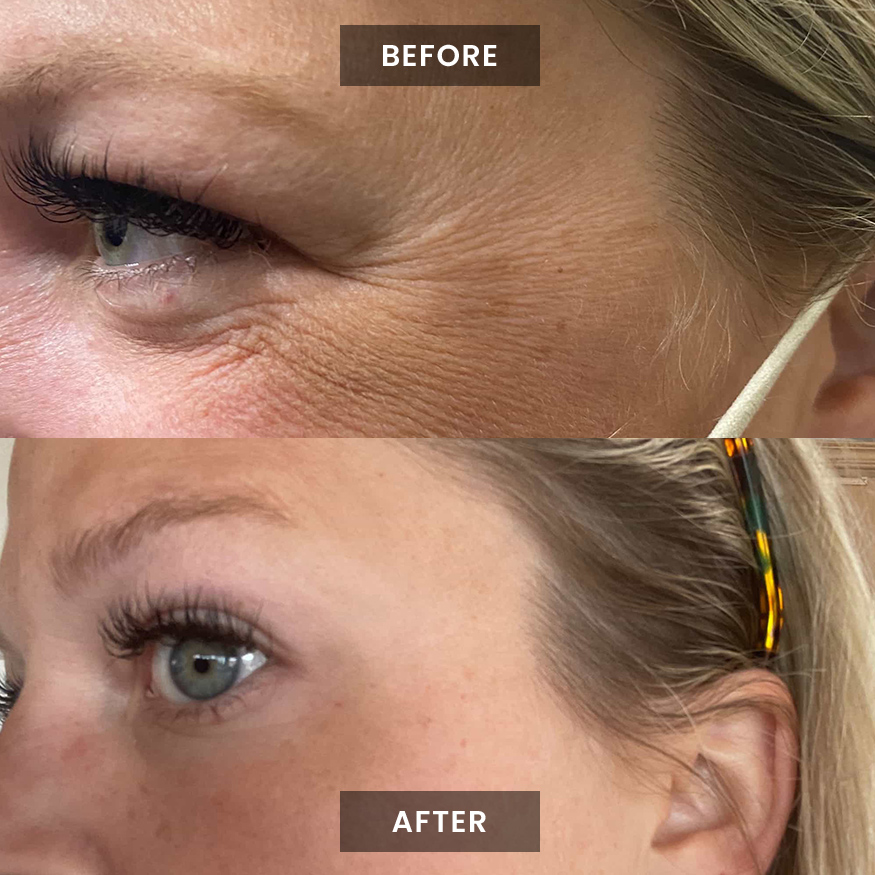 Xeomin before and after photo